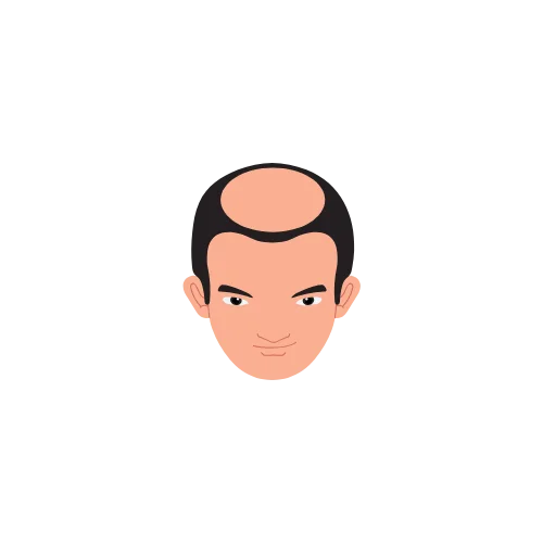 Hair Loss Type 2