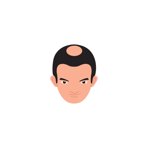 Hair Loss Type 3