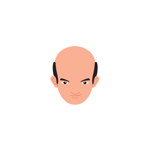 Hair Loss Type 5