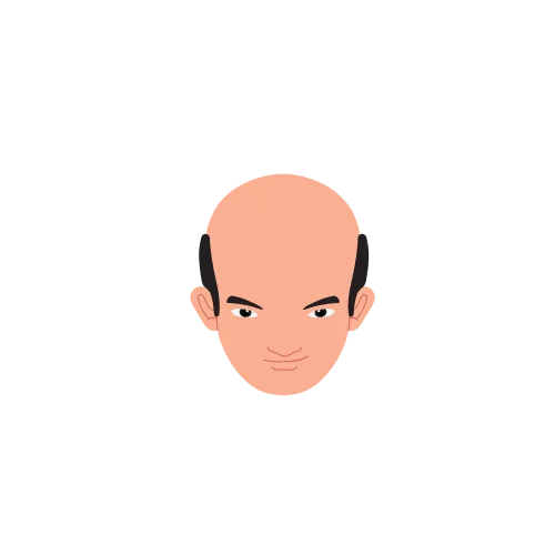 Hair Loss Type 5