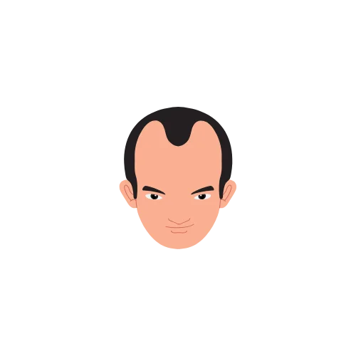 Hair Loss Type 6