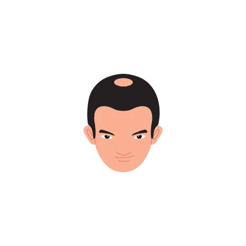 Hair Loss Type 7