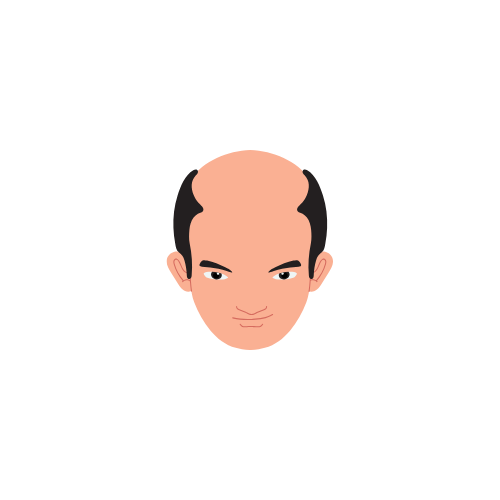 Hair Loss Type 8