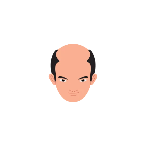 Hair Loss Type 8