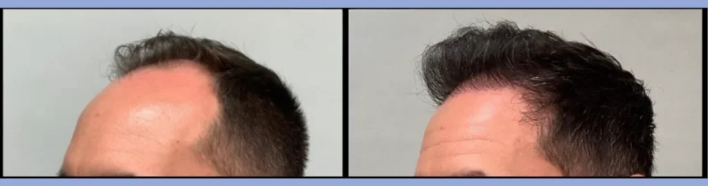 Hair Transplant Before After Lucknow E1735377587803 1024X270