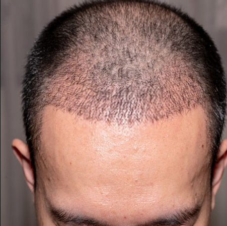 What Does Cost Per Graft Mean