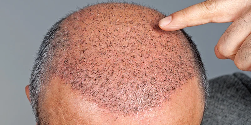Is Hair Transplant Permanent