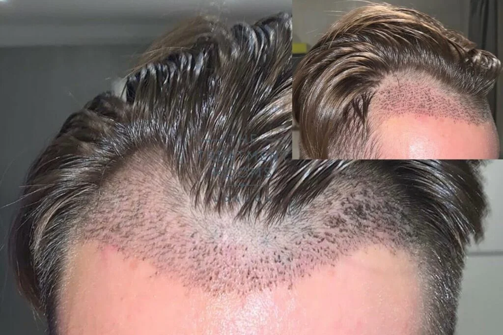 7 Days Post Hair Transplant 1024X682