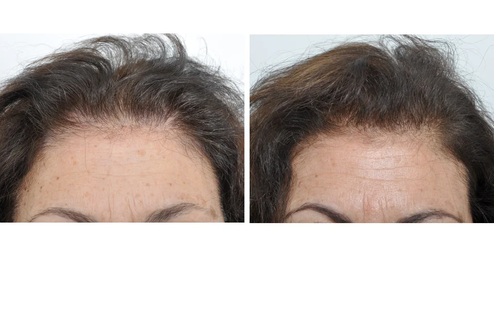Hair Transplant Process