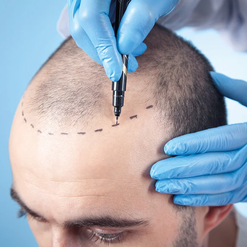 Is Hair Transplant Safe