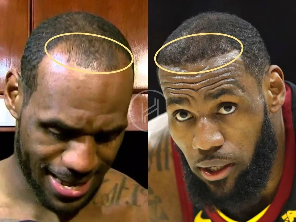 Lebron James Hairline Hair Transplant Before And After