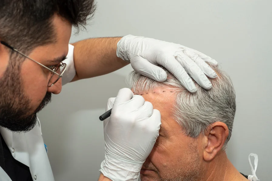 Is Hair Transplant Safe