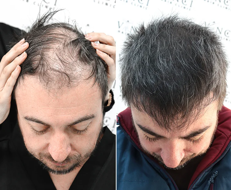 Hair Transplant