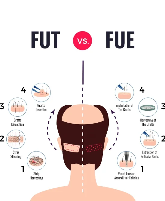 fue vs fut