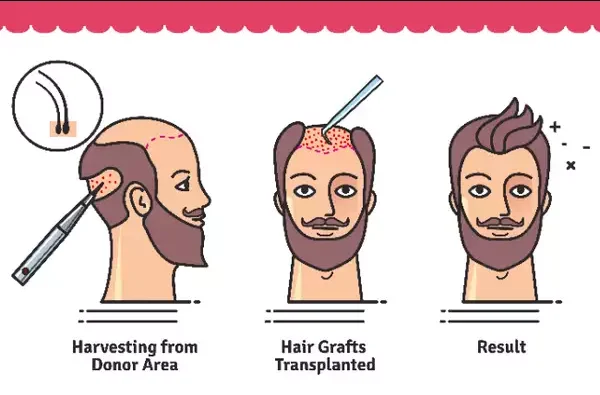 Are hair transplants permanent?