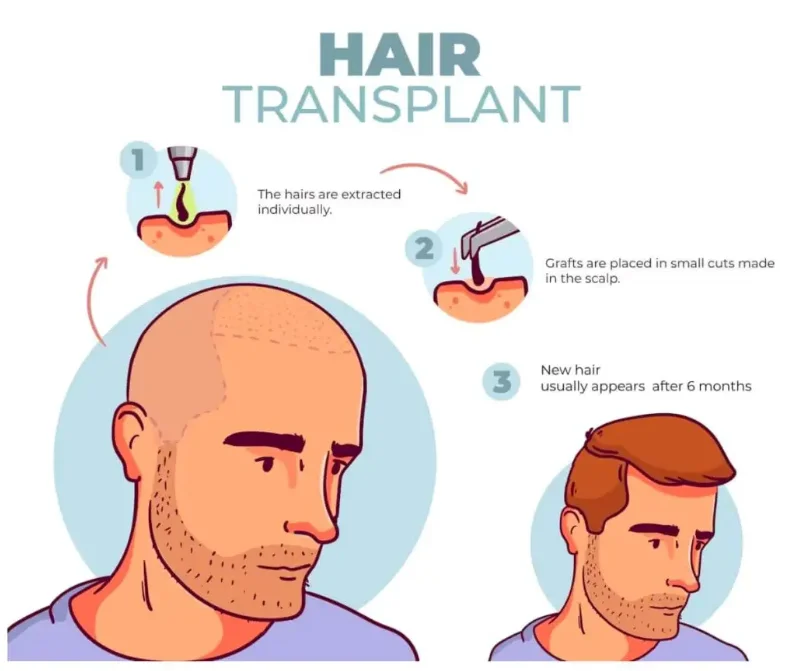 Hair Transplant