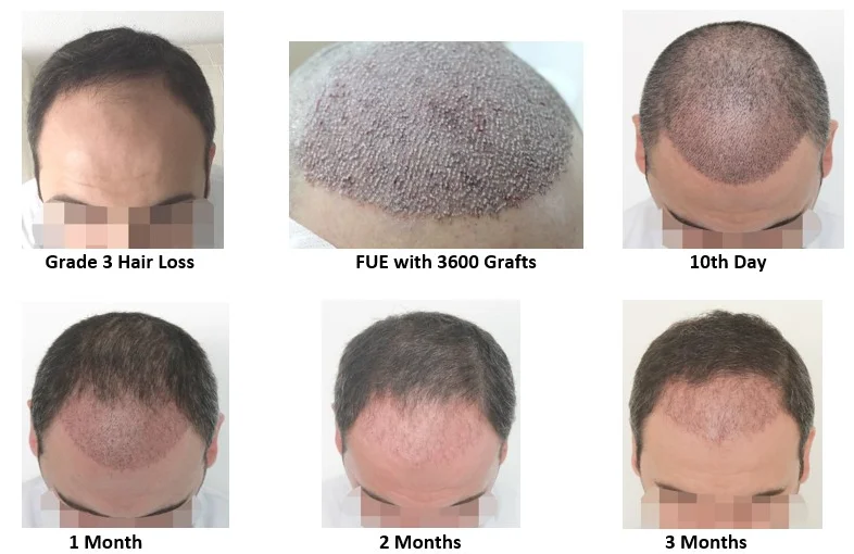 Does Transplanted Hair Grow?