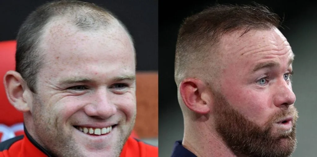 Celeb Hair Transplant 3 1024X507