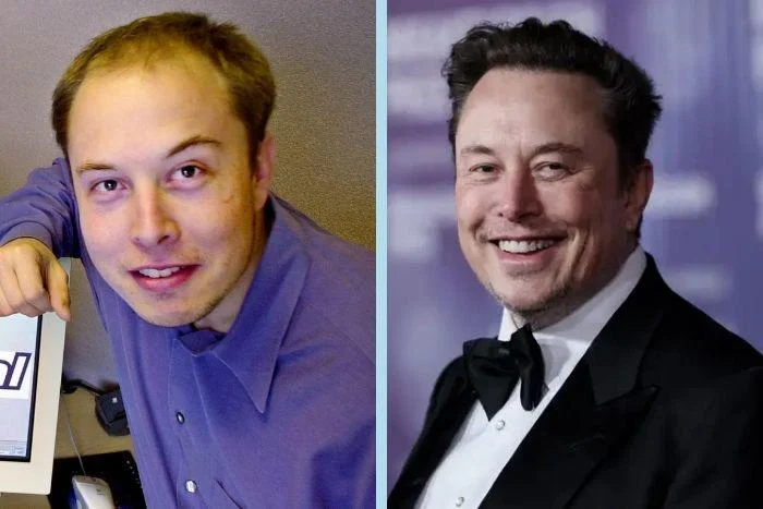 Did Elon Musk Get A Hair Transplant
