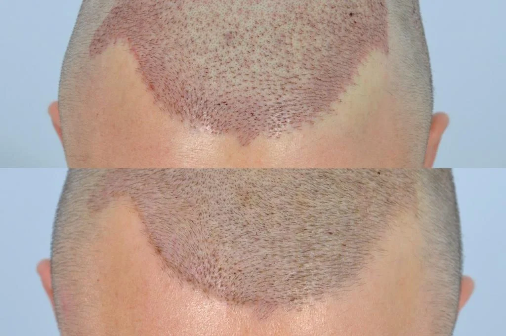 Is Hair Transplant Painful