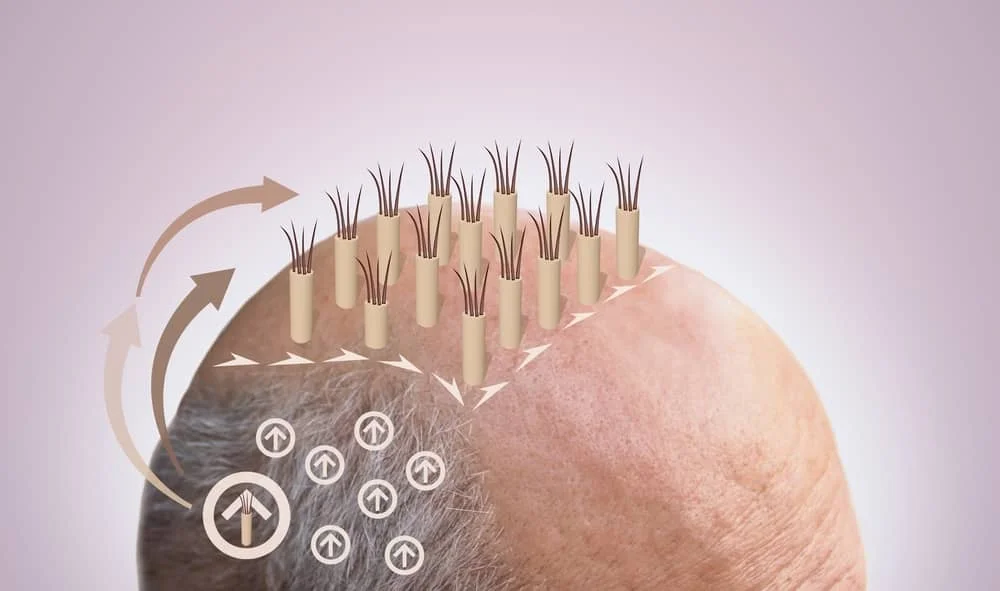 How Does Hair Transplant Work