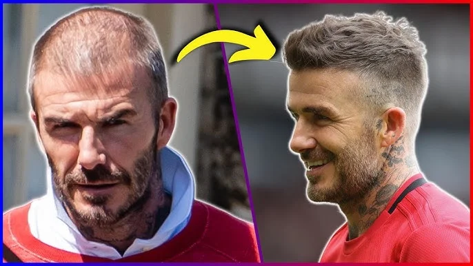Celebrity Hair Transplant Before After