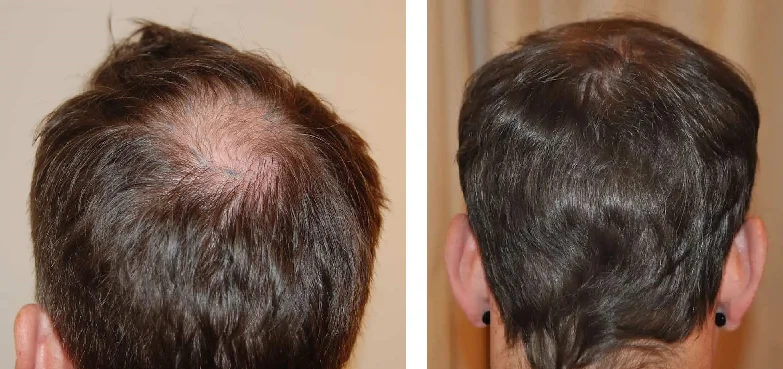 Does Transplanted Hair Fall Out